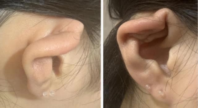 Nữ sinh 15 tuổi xỏ lỗ tai gây viêm màng sụn, biến dạng vành tai, chuyên gia cảnh báo - Ảnh 1.