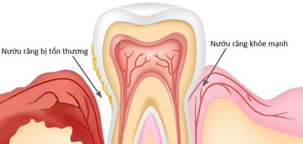 Căn bệnh gây rụng răng nhiều người mắc phải - Ảnh 1.