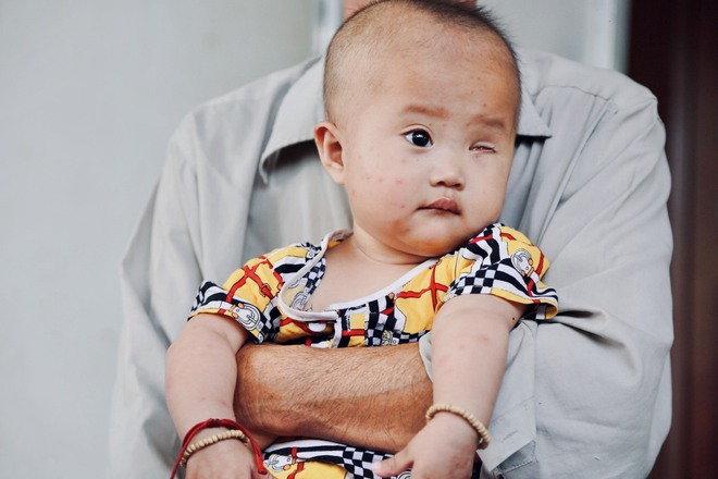Lời khẩn cầu của ông nội xin cứu bé gái 14 tháng tuổi phải bỏ một bên mắt vì ung thư - Ảnh 2.