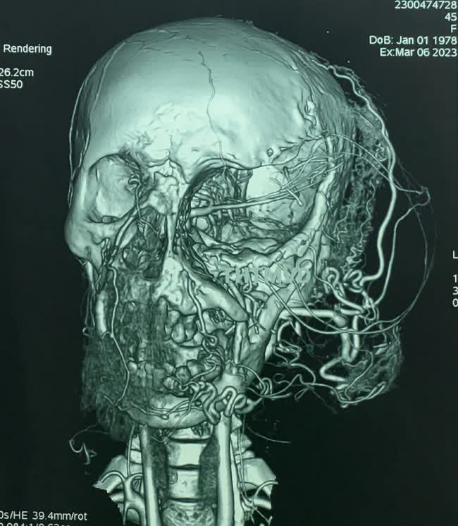 Người phụ nữ mang khối u vùng mặt to như chiếc đầu thứ hai - Ảnh 1.