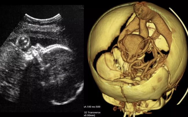 Ca phẫu thuật não đầu tiên trên thai nhi trong bụng mẹ được thực hiện - Ảnh 1.