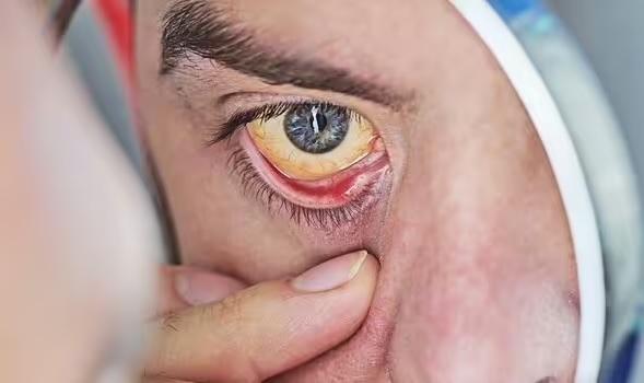 Bác sĩ lên truyền hình, cảnh báo 2 dấu hiệu ở mắt có thể ‘gióng lên hồi chuông cảnh báo’ bệnh tật - Ảnh 3.