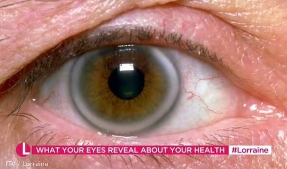 Bác sĩ lên truyền hình, cảnh báo 2 dấu hiệu ở mắt có thể ‘gióng lên hồi chuông cảnh báo’ bệnh tật - Ảnh 2.