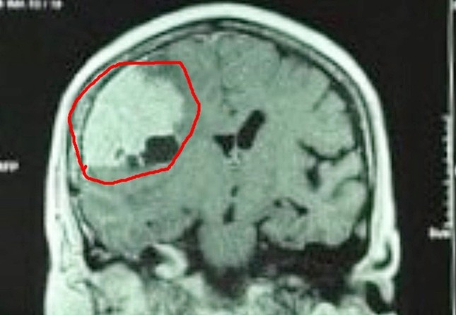 Đau đầu kéo dài vì khối u màng não khổng lồ - Ảnh 1.