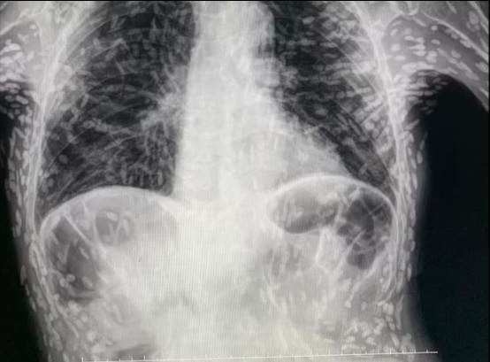 Xem ảnh X-quang của bệnh nhân bị ho, bác sĩ phát hiện thủ phạm đáng sợ - Ảnh 1.