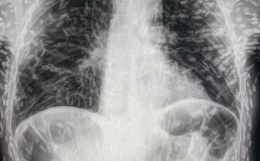Xem ảnh X-quang của bệnh nhân bị ho, bác sĩ phát hiện 'thủ phạm' đáng sợ