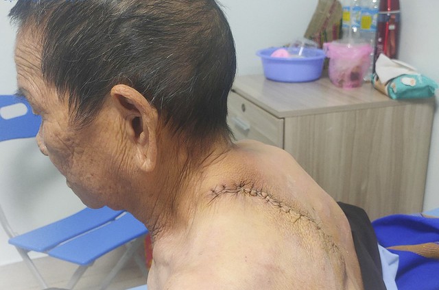 Phẫu thuật cắt bỏ thành công khối u khổng lồ trên lưng cụ bà 95 tuổi - Ảnh 2.