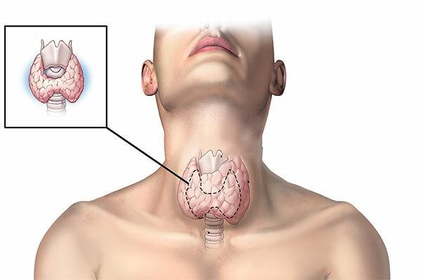 Dấu hiệu bất thường cảnh báo nguy cơ bị ung thư tuyến giáp, tuyệt đối không được bỏ qua - Ảnh 1.