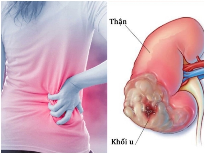 5 dấu hiệu cảnh báo ung thư thận không nên bỏ qua - Ảnh 1.