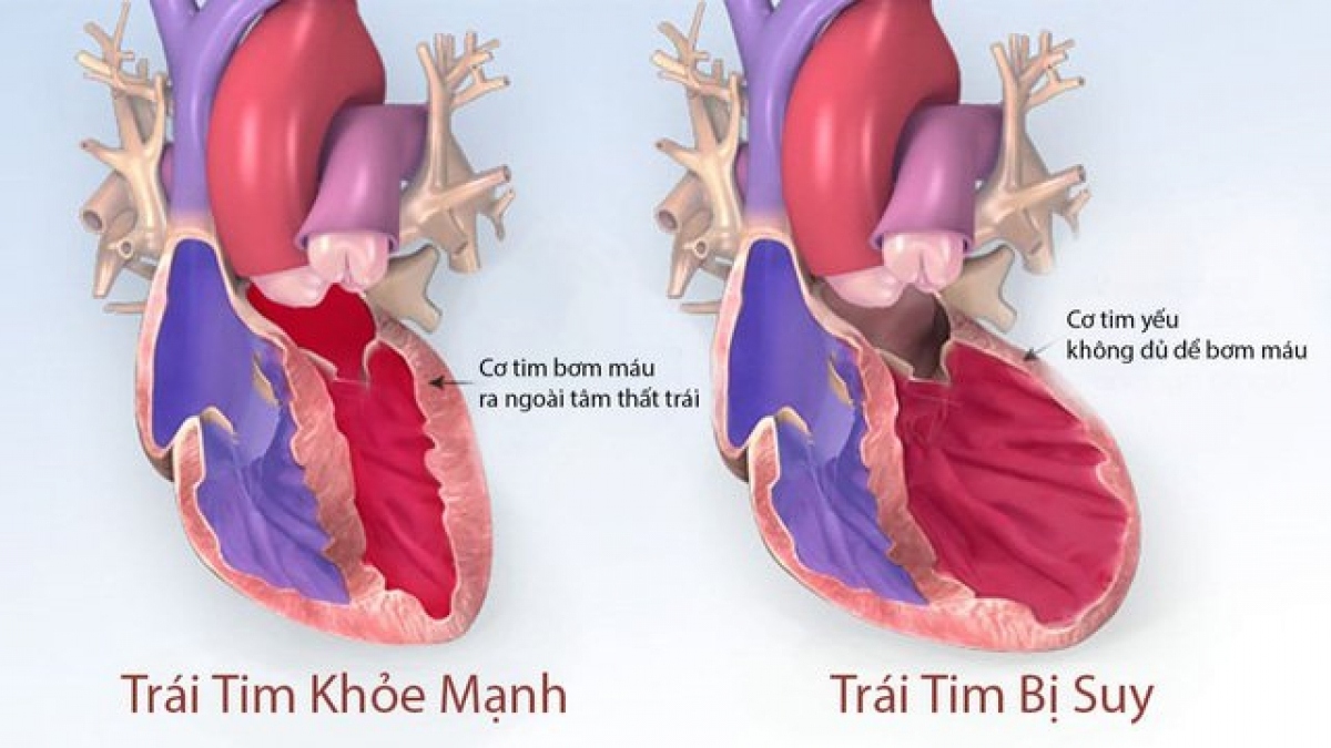 Bé 1 tuổi bị cao huyết áp - Ảnh 1.