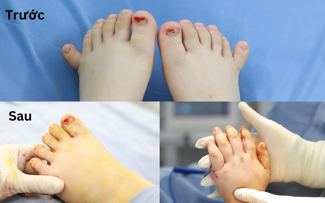 Em bé có 12 ngón tay, 12 ngón chân cực kỳ hiếm gặp - Ảnh 2. Em bé có 12 ngón tay, 12 ngón chân cực kỳ hiếm gặp - Ảnh 2.