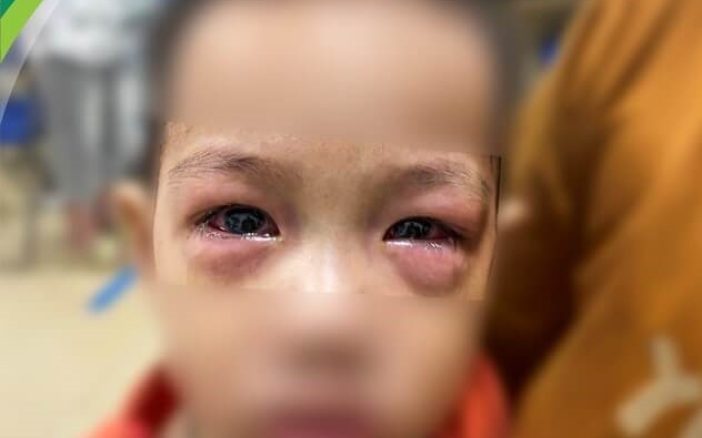 Bệnh đau mắt đỏ lây lan cả nước, bác sĩ đưa những cách hạn chế nhiễm bệnh trong giai đoạn này - Ảnh 3.