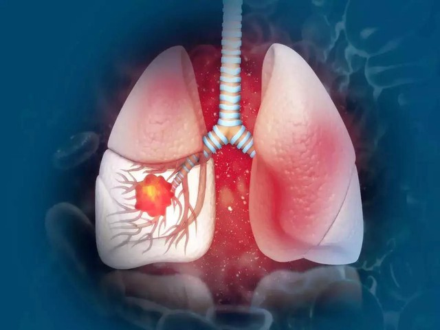 Dấu hiệu cảnh báo ung thư phổi có thể xuất hiện vào buổi sáng: Số 3 65% người mắc đều có - Ảnh 1.