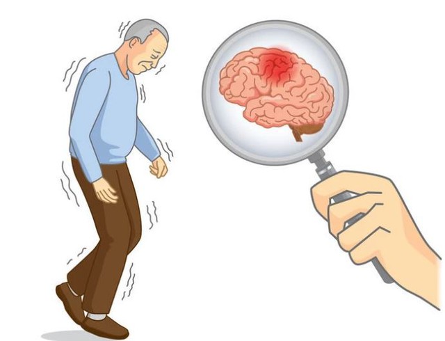 Chạy 5km/ngày, người đàn ông 65 tuổi vẫn bị nhồi máu não: Nguyên nhân đến từ thứ ít ai ngờ đến - Ảnh 1.