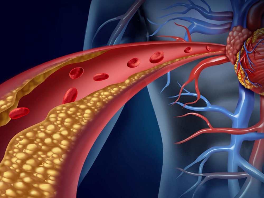 Dấu hiệu cholesterol cao lộ rõ trên gương mặt, đừng bỏ qua - Ảnh 1.