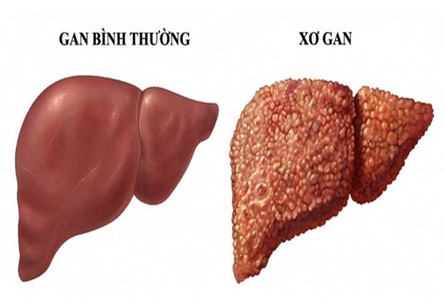 Thường xuyên uống rượu bia, những người này dễ bị bệnh xơ gan ‘ghé thăm’- Ảnh 2.