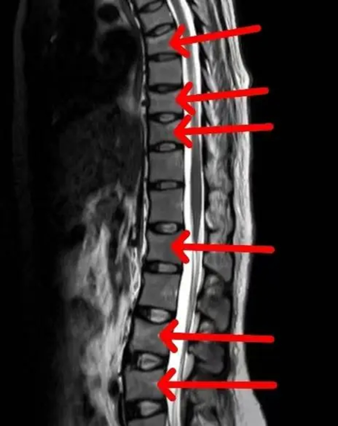 1. Cảnh báo loãng xương sớm ở phụ nữ sau sinh nở: Đừng coi thường các cơn đau lưng bất thường!.