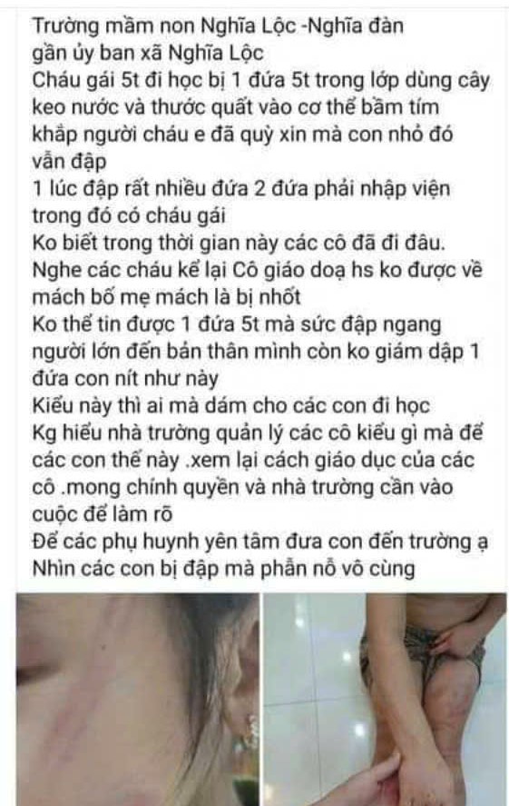 Nhiều trẻ mầm non bị bạn đánh bầm tím tại Nghệ An - Ảnh 1.