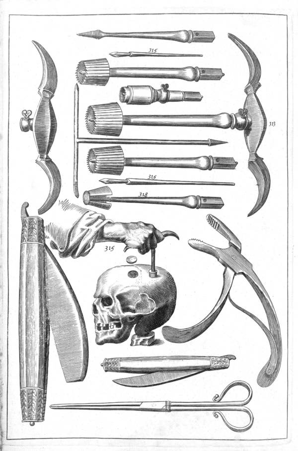 Trepanation: Thủ tục phẫu thuật sọ lâu đời nhất thế giới vẫn tồn tại đến ngày nay!- Ảnh 6.