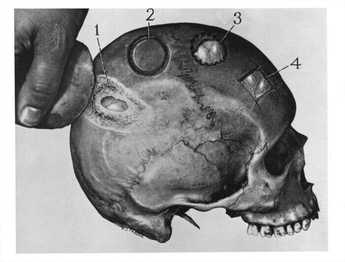 Trepanation: Thủ tục phẫu thuật sọ lâu đời nhất thế giới vẫn tồn tại đến ngày nay!- Ảnh 3.