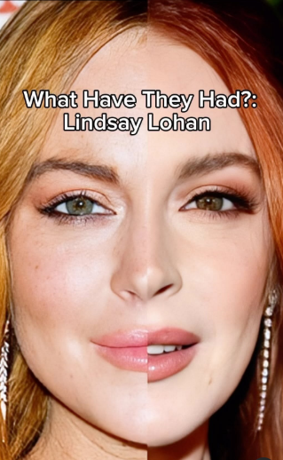 Bí ẩn của "thần dược cải lão hoàn đồng": Cách Lindsay Lohan và loạt sao Hollywood sử dụng để cứu vớt nhan sắc tới ngày "cận date"?- Ảnh 8.