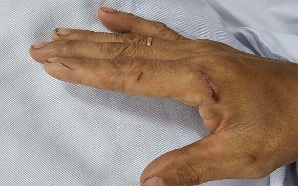 Nhiễm liên cầu lợn dù không ăn tiết canh