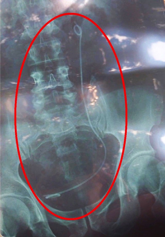 Lâm Đồng: Nhầm kết quả X-quang, bệnh nhân phải thực hiện nội soi tìm dị vật- Ảnh 3.