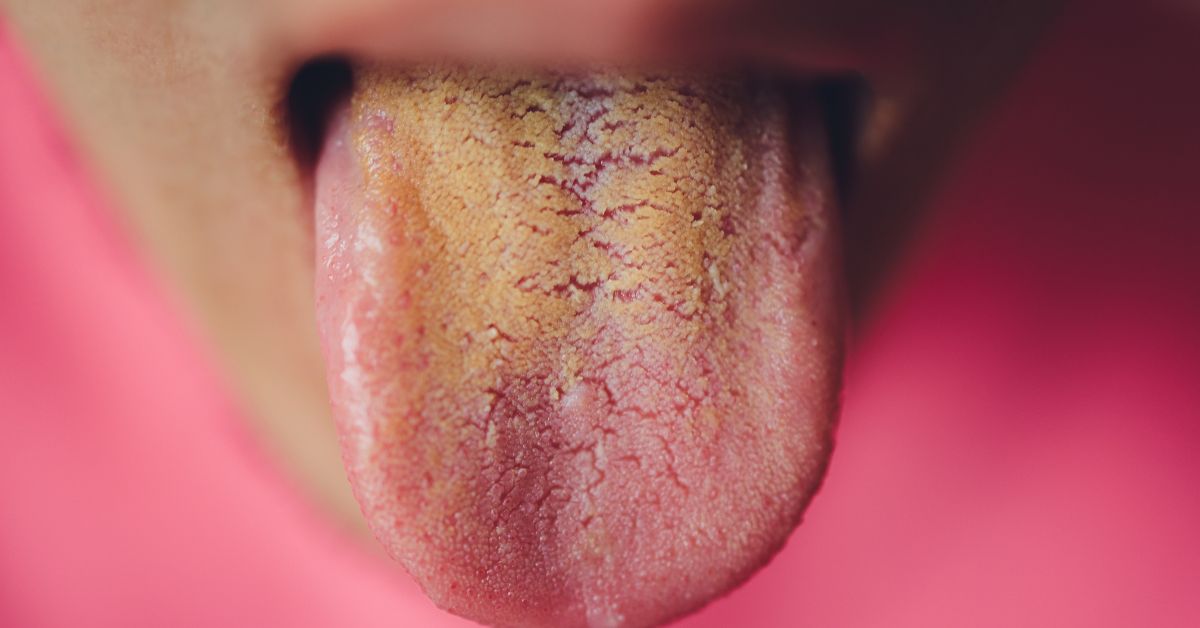 5 điều lưỡi có thể tiết lộ về sức khỏe - từ ung thư đến nguy cơ đột quỵ cũng có thể hiện ra- Ảnh 1.