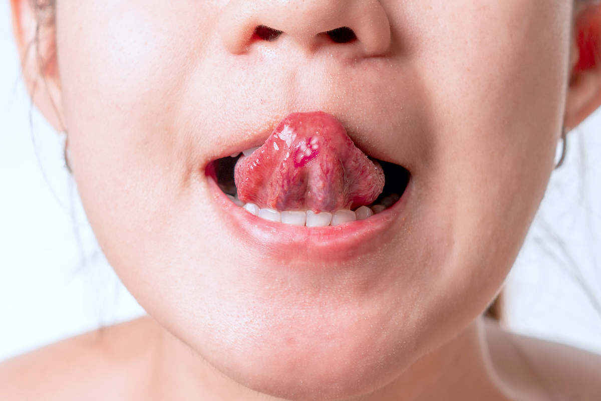 5 điều lưỡi có thể tiết lộ về sức khỏe - từ ung thư đến nguy cơ đột quỵ cũng có thể hiện ra- Ảnh 2.