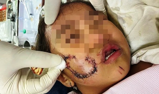 Bé gái 5 tuổi bị chó cắn phải khâu 50 mũi- Ảnh 1.