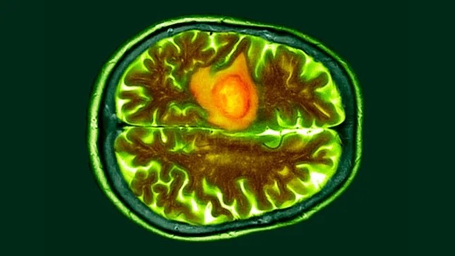 Có thể thu nhỏ các khối u não chết người mà không cần hóa trị, xạ trị ?- Ảnh 1.