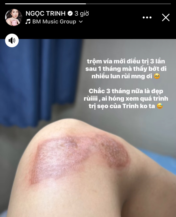 Sau 1 tháng điều trị, Ngọc Trinh tiết lộ hình ảnh vết thương do tai nạn khi "diễn xiếc" trên mô tô để lại- Ảnh 1.
