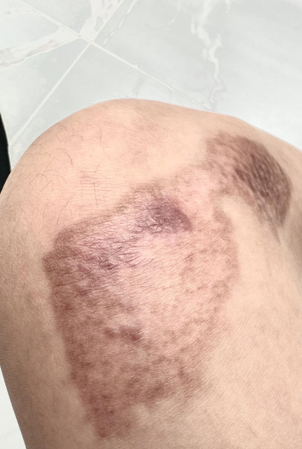 Sau 1 tháng điều trị, Ngọc Trinh tiết lộ hình ảnh vết thương do tai nạn khi "diễn xiếc" trên mô tô để lại- Ảnh 3.