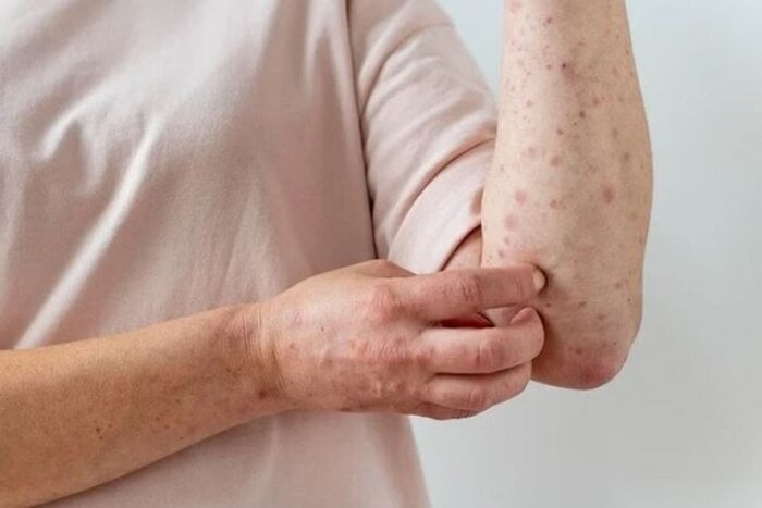 Ghi nhận 78 ca nghi mắc sởi và rubella, Bộ Y tế chỉ đạo nóng- Ảnh 1.