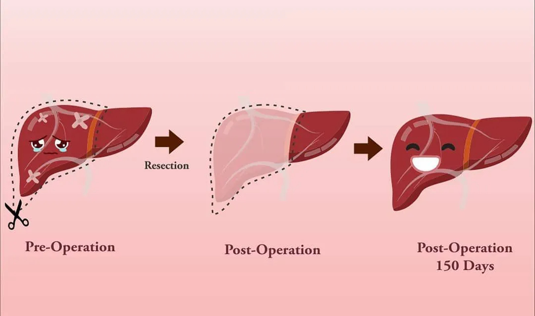 Sau mỗi bữa nhậu, một phần lá gan của bạn sẽ chết: Gan mới sẽ mọc ra sau 5 tiếng, nhưng hậu quả lâu dài mới là thứ thực sự đáng sợ- Ảnh 2.