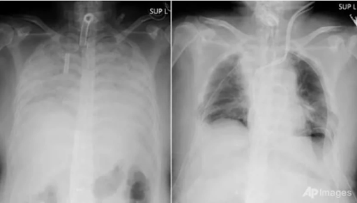 Chụp X-quang phát hiện nhiều người trẻ phổi trắng xóa, nguyên nhân vì đâu?- Ảnh 2.