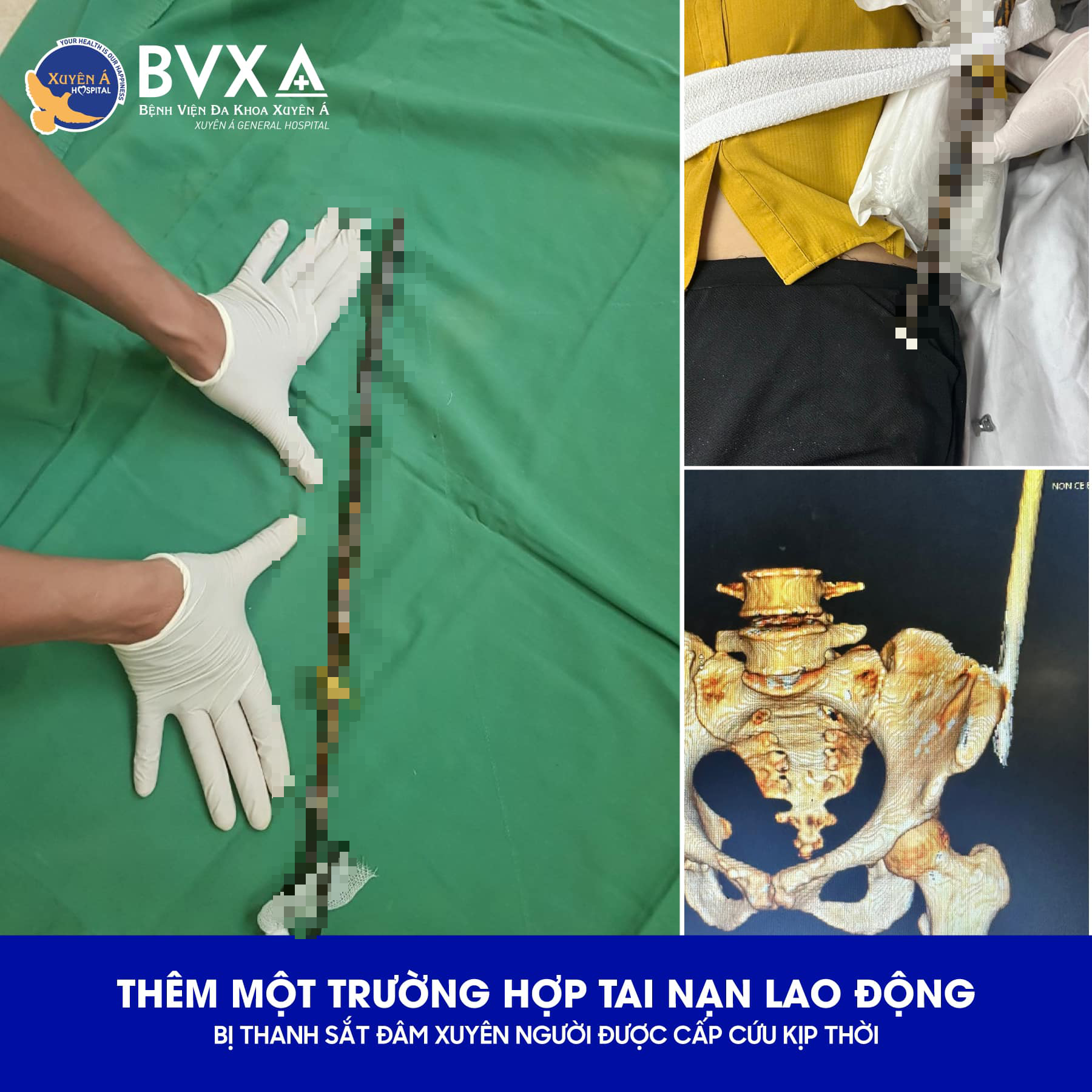 Người phụ nữ vào viện cùng thanh sắt xuyên mông- Ảnh 1.