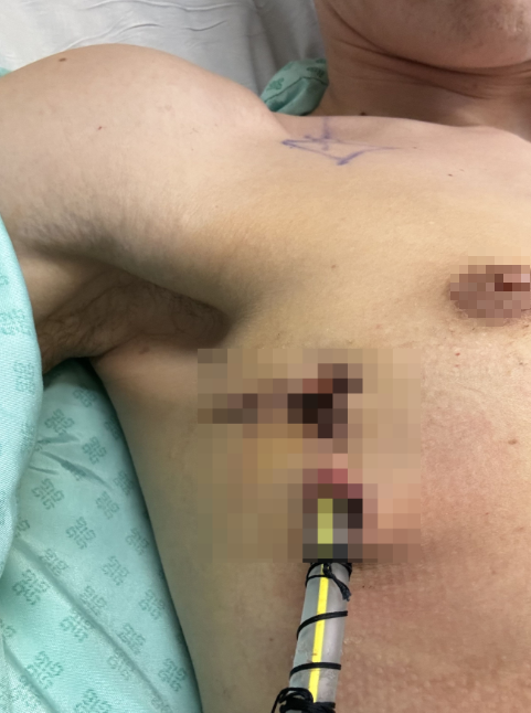 Thanh niên 29 tuổi đang khỏe bỗng ngã quỵ, ngực đau như bị đâm: Bác sĩ nói do 1 thói quen cực có hại- Ảnh 3.