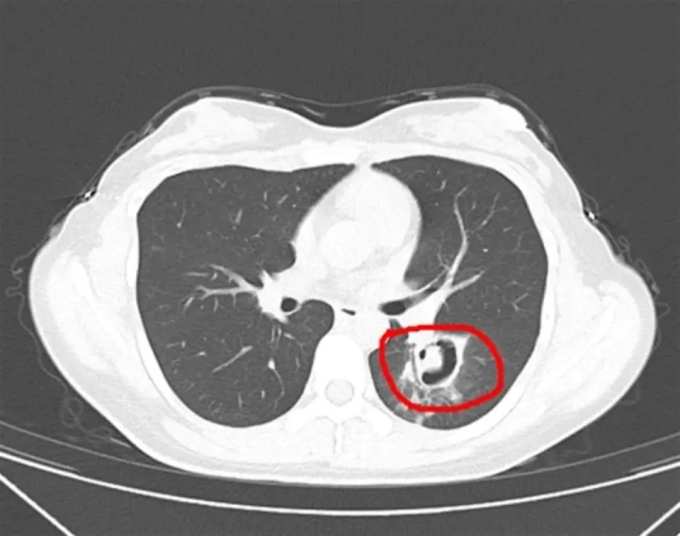 Dọn dẹp tủ quần áo, cô gái 24 tuổi mắc viêm phổi, bác sĩ nhắc một việc cần làm- Ảnh 1.