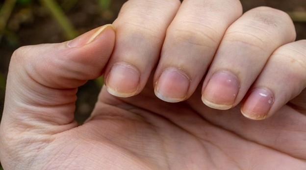 Dấu hiệu ít được chú ý trên móng tay có thể cảnh báo bạn về bệnh ung thư- Ảnh 2.