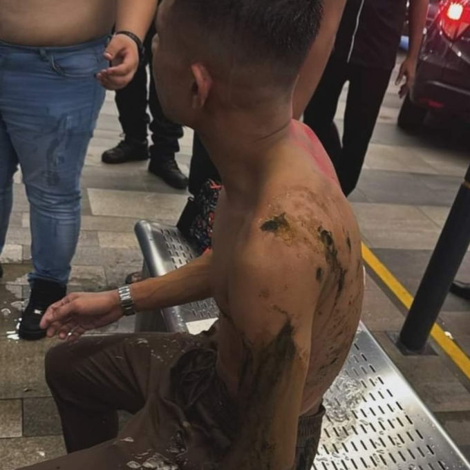 Đã bắt được nghi phạm tạt axit cầu thủ Malaysia, nhìn hình ảnh da bong tróc khiến ai cũng rùng mình- Ảnh 1.