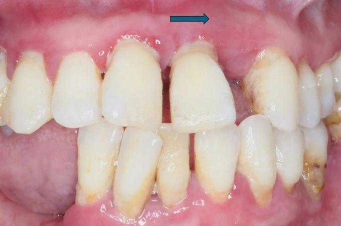 Bác sĩ cảnh báo thói quen nhiều người cứ ăn xong là làm, khiến răng càng ngày càng thưa, thậm chí làm teo nướu- Ảnh 2.