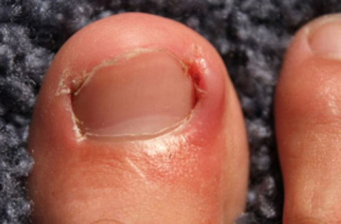 Xem nhẹ 1 khó chịu thường gặp ở móng tay, người đàn ông phải cắt cụt ngón trỏ vì ung thư- Ảnh 2.