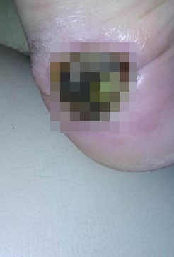 Cô gái 24 tuổi phải cắt cụt một chân vì vết phồng rộp nhỏ do đi giày thể thao, cảnh báo "điều có thể xảy ra với bất cứ ai"- Ảnh 3.
