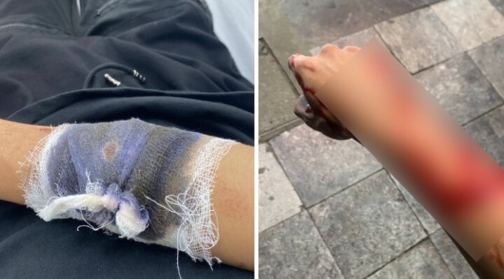 Thanh niên bị chém, cướp xe máy trước Nhà hát Lớn Hà Nội- Ảnh 1.