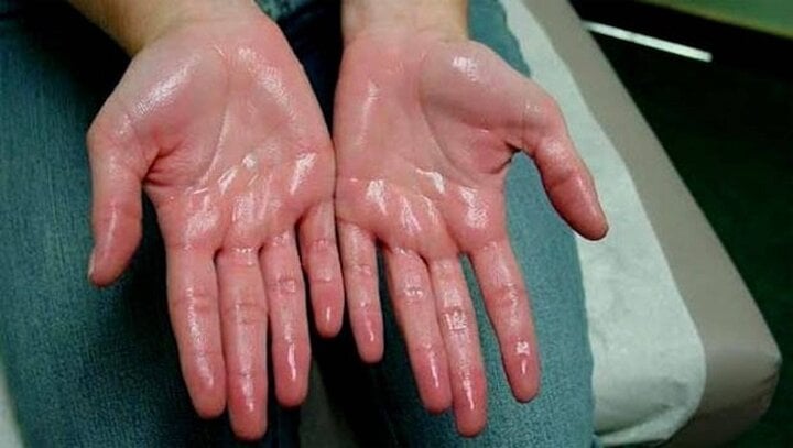 Khổ sở vì chứng đổ mồ hôi 'vô tội vạ'- Ảnh 5.