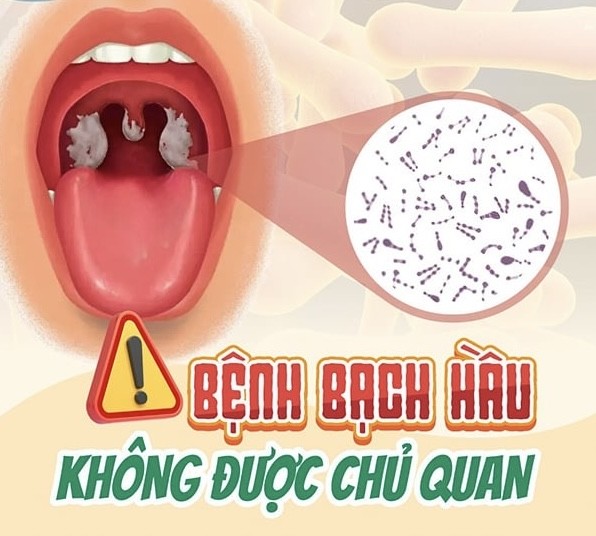 Bạch hầu là bệnh gì, vì sao có thể tử vong trong vài ngày?- Ảnh 1.