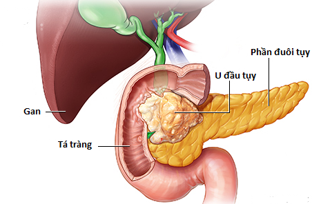 Chàng trai 29 tuổi bị đau lưng, BS nói chỉ còn sống được nửa năm, nguyên nhân do căn bệnh ung thư "giỏi ngụy trang"- Ảnh 4.