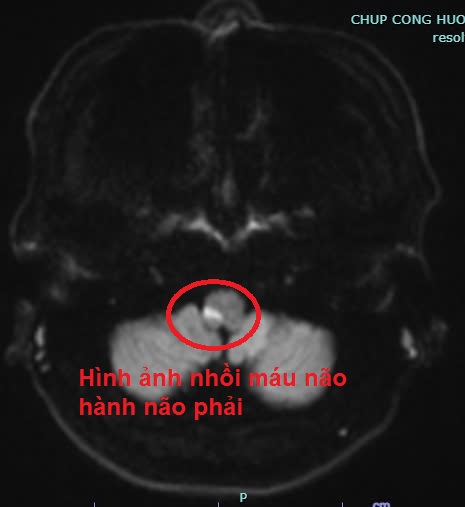 Chóng mặt sau khi uống rượu, người đàn ông tưởng say nhập viện mới biết đột quỵ - Ảnh 1.