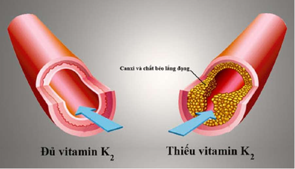 Nghịch lý canxi - Không chỉ ảnh hưởng tới xương mà còn cả tim mạch của bé - Ảnh 1.